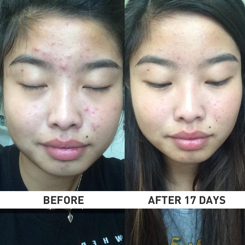 Vitamin B5 Acne